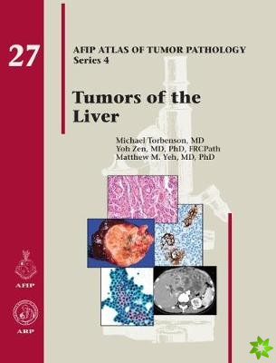 Tumors of the Liver