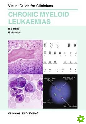 Chronic Myeloid Leukaemias