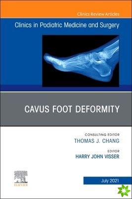 Cavus Foot Deformity, An Issue of Clinics in Podiatric Medicine and Surgery