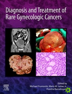 Diagnosis and Treatment of Rare Gynecologic Cancers