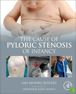 Cause of Pyloric Stenosis of Infancy
