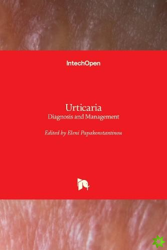 Urticaria