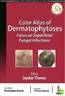 Color Atlas of Dermatophytoses