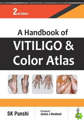 Handbook of Vitiligo & Color Atlas