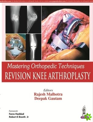 Mastering Orthopedic Techniques: Revision Knee Arthroplasty