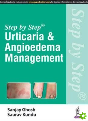 Step by Step: Urticaria & Angioedema Management