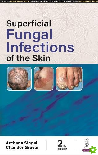 Superficial Fungal Infections of the Skin