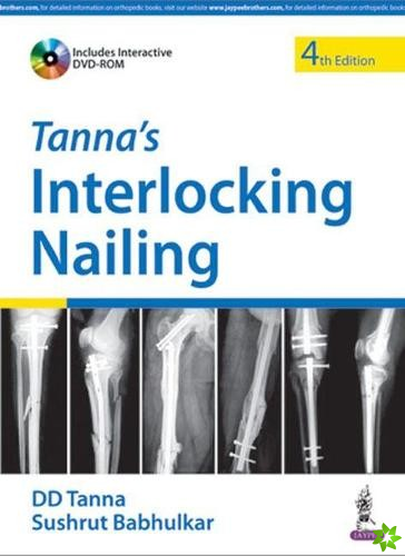 Tanna's Interlocking Nailing