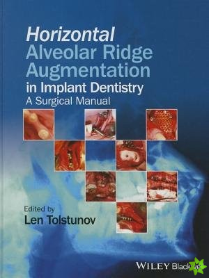 Horizontal Alveolar Ridge Augmentation in Implant Dentistry - A Surgical Manual