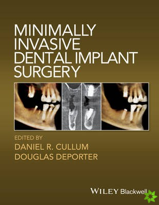 Minimally Invasive Dental Implant Surgery