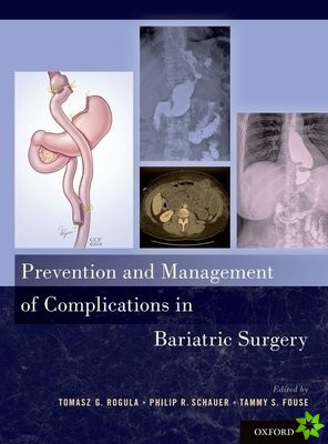 Prevention and Management of Complications in Bariatric Surgery
