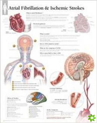Atrial Fib & Ischemic Strokes Paper Poster