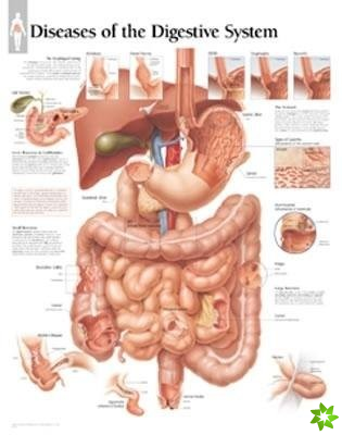 Diseases of the Digestive System Paper Poster
