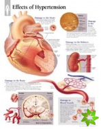 Effects of Hypertension Laminated Poster