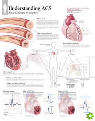 Understanding ACS (Acute Coronary Syndrome) Laminated Poster