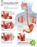 Understanding GERD (Gastroesophageal Reflux Disease) Paper Poster