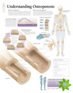 Understanding Osteoporosis Paper Poster