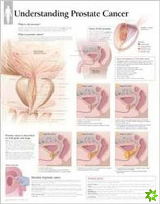 Understanding Prostate Cancer Laminated Poster