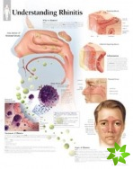 Understanding Rhinitis Laminated Poster