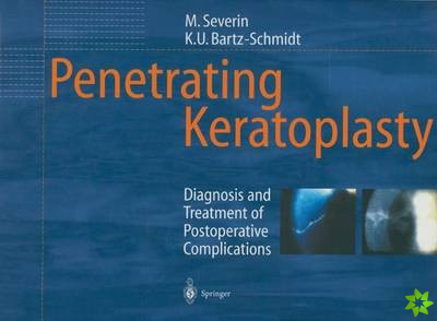 Penetrating Keratoplasty
