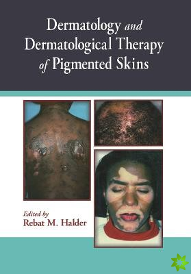 Dermatology and Dermatological Therapy of Pigmented Skins