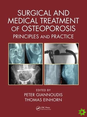 Surgical and Medical Treatment of Osteoporosis