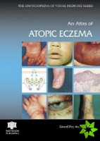 Atlas of Atopic Eczema