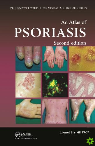 Atlas of Psoriasis, Second Edition