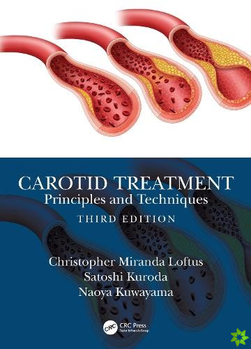 Carotid Treatment: Principles and Techniques