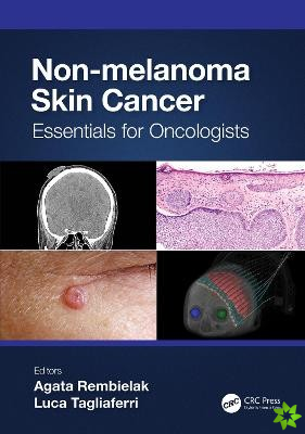 Non-melanoma Skin Cancer