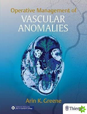 Operative Management of Vascular Anomalies