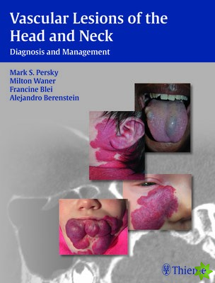 Vascular Lesions of the Head and Neck