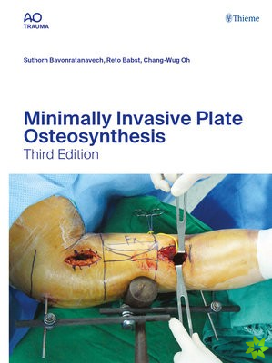 Minimally Invasive Plate Osteosynthesis