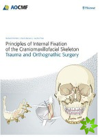 Principles of Internal Fixation of the Craniomaxillofacial Skeleton