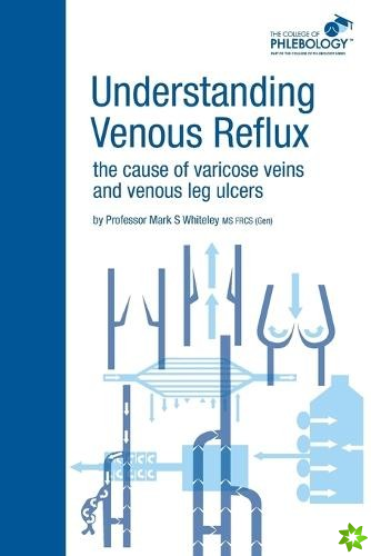 Understanding Venous Reflux the Cause of Varicose Veins and Venous Leg Ulcers